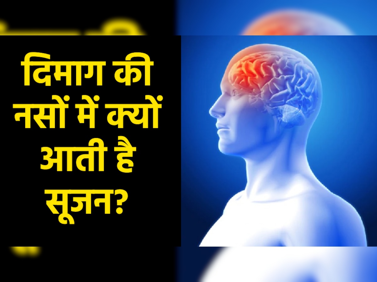 Brain AVM: दिमाग की नसों में क्यों आती है सूजन? नस फटने से पहले मिलते हैं ये 5 चेतावनी संकेत