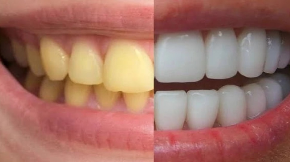 Dental care Teeth Cleaning tips know how to make teeth strong and white