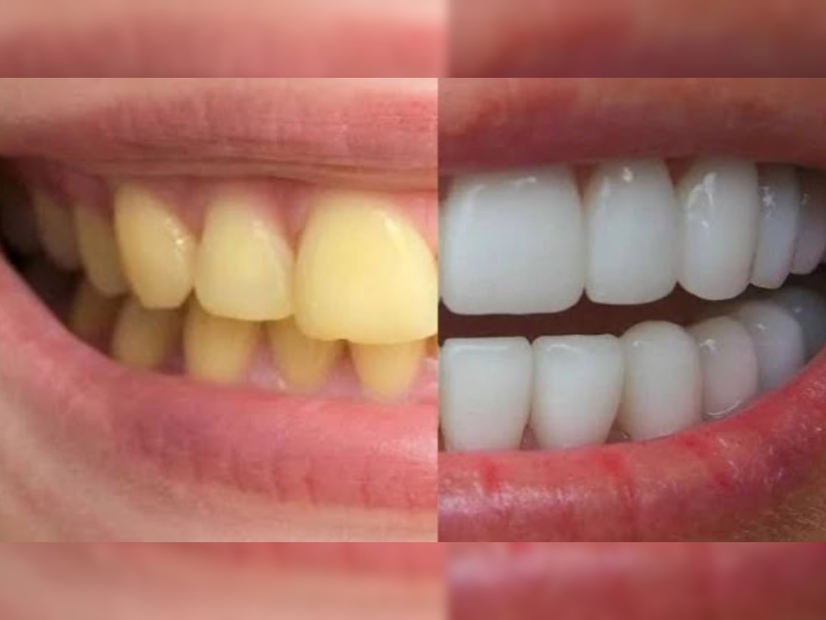 Teeth Cleaning: पीले दांतों से आप भी पा सकते हैं छुटकारा, बस करें ये कुछ जरूरी काम