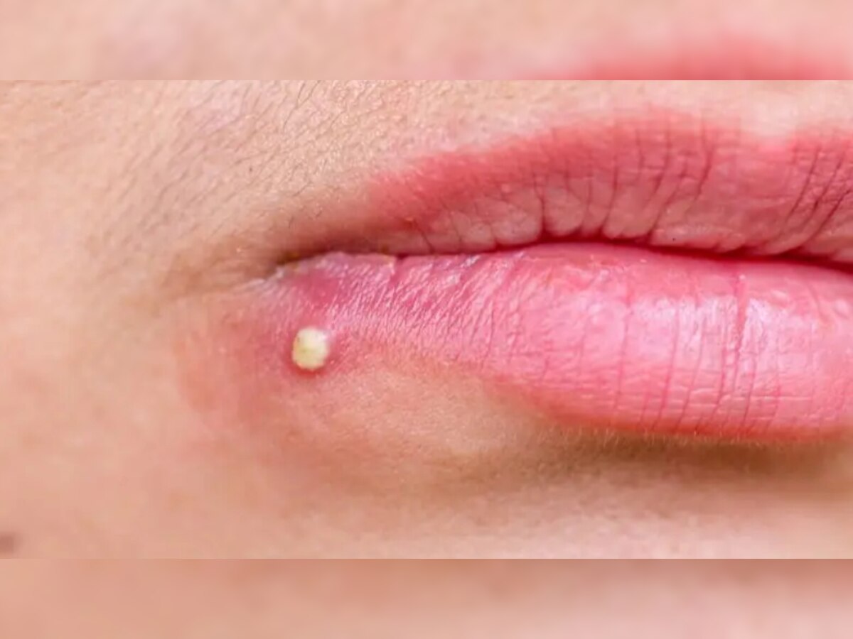 Pimples Treatment: पिंपल्स और मुंहासे को इन तरीको से करें ठीक, कुछ ही दिनों में खिल उठेगा चेहरा!