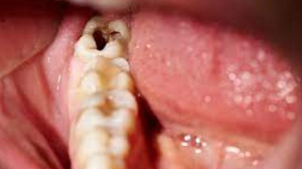 Teeth Cavity: दांत में कैविटी की समस्या ये आप भी हैं परेशान, तो इन तरीकों से करें दूर Teeth Cavity: दांत में कैविटी की समस्या ये आप भी हैं परेशान, तो इन तरीकों से करें दूर