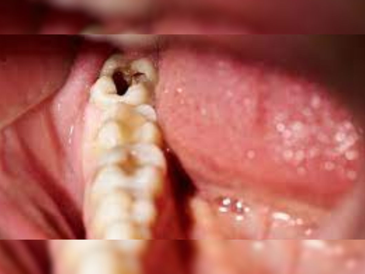 Teeth Cavity: दांत में कैविटी की समस्या ये आप भी हैं परेशान, तो इन तरीकों से करें दूर