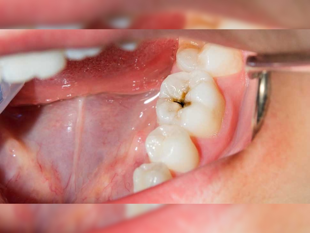 Teeth Cavities: दातों को कैविटी से बचाना चाहते हैं तो आज से शुरू करे दें ये काम