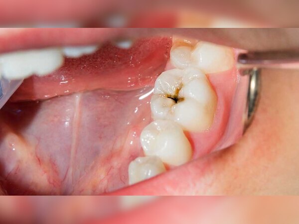 Teeth Cavities: दातों को कैविटी से बचाना चाहते हैं तो आज से शुरू करे दें ये काम