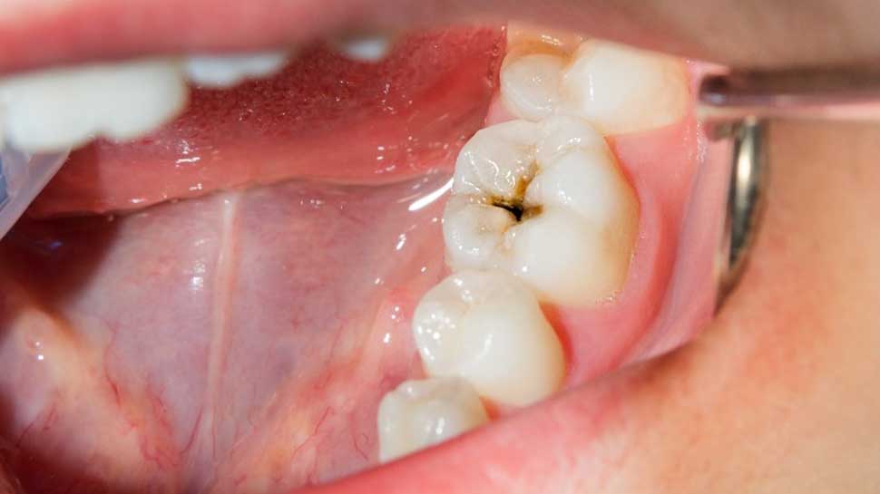 Teeth Cavities: दातों को कैविटी से बचाना चाहते हैं तो आज से शुरू करे दें ये काम Teeth Cavities: दातों को कैविटी से बचाना चाहते हैं तो आज से शुरू करे दें ये काम