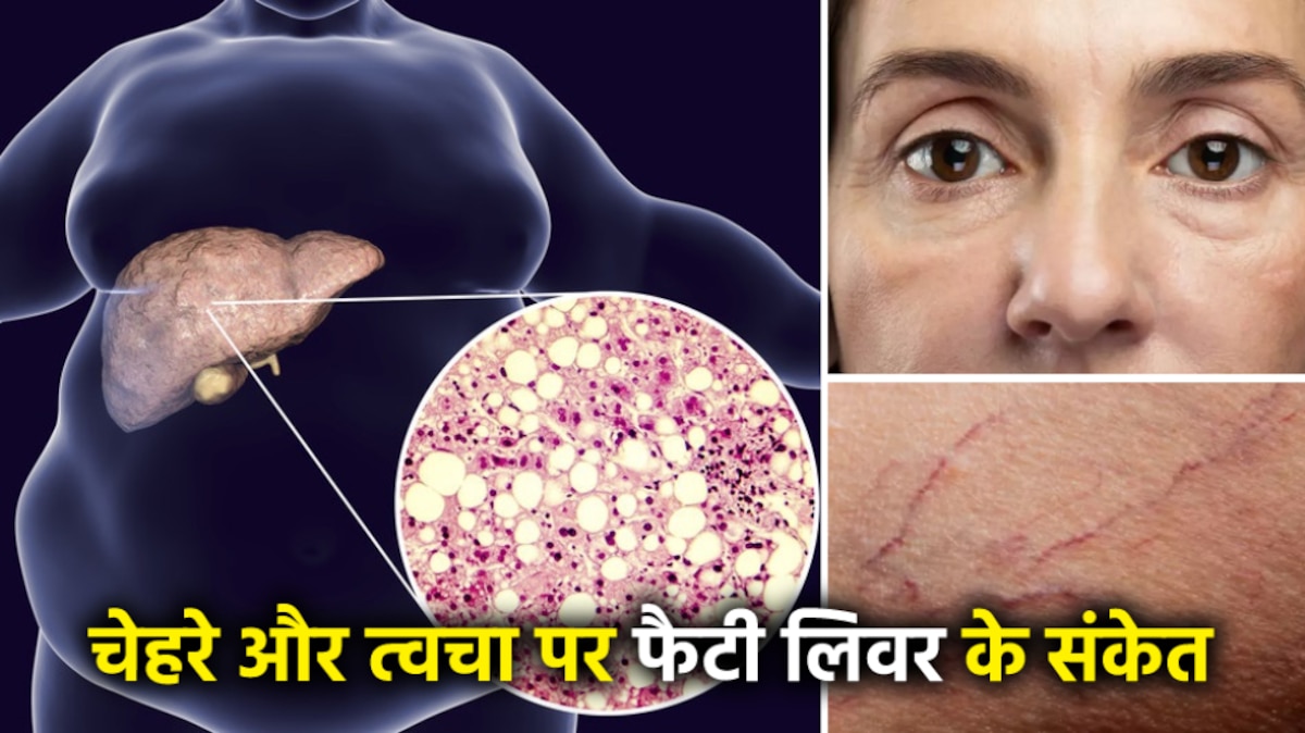 Fatty liver disease symptoms: sign of fatty liver are also found on face and skin | Signs Of Fatty Liver: चेहरे और त्वचा पर भी मिलते हैं फैटी लिवर डिजीज के संकेत,