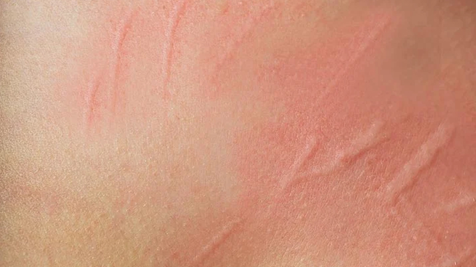 अजीब बीमारी से डॉ0 हैरान, शख्स की त्वचा के नीचे रेंगते नजर आए कीड़े, जानें पूरा मामला अजीब बीमारी से डॉ0 हैरान, शख्स की त्वचा के नीचे रेंगते नजर आए कीड़े, जानें पूरा मामला