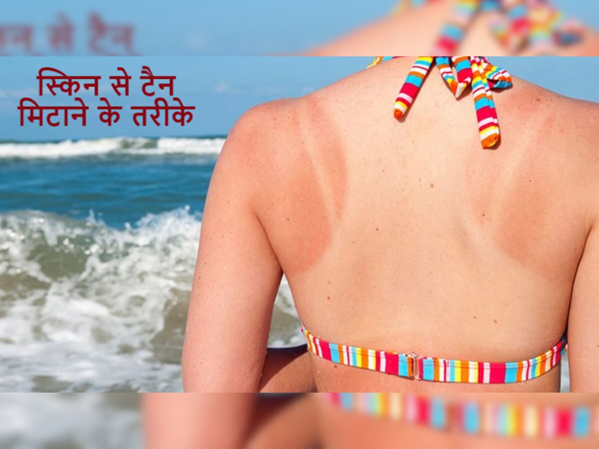 Skin Tanning: तेज धूप पड़ने की वजह से स्किन हो गई टैन? ऐसे दूर होगा कालापन