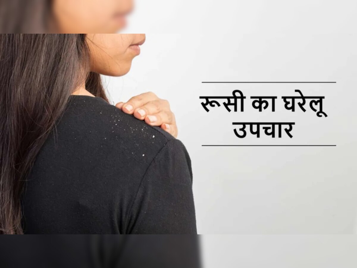 Dandruff Solution: बालों से झड़ते डैंड्रफ ने कर दिया है शर्मिंदा? बस पानी में मिलाकर लगाएं ये चीज, दूर होगी समस्या