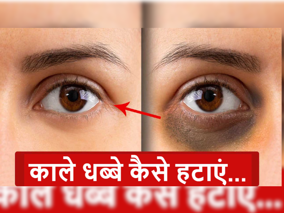 Dark Circles Treatment: चुकंदर में मिलाकर लगाएं बादाम का तेल, डार्क सर्कल्स की समस्या होगी दूर