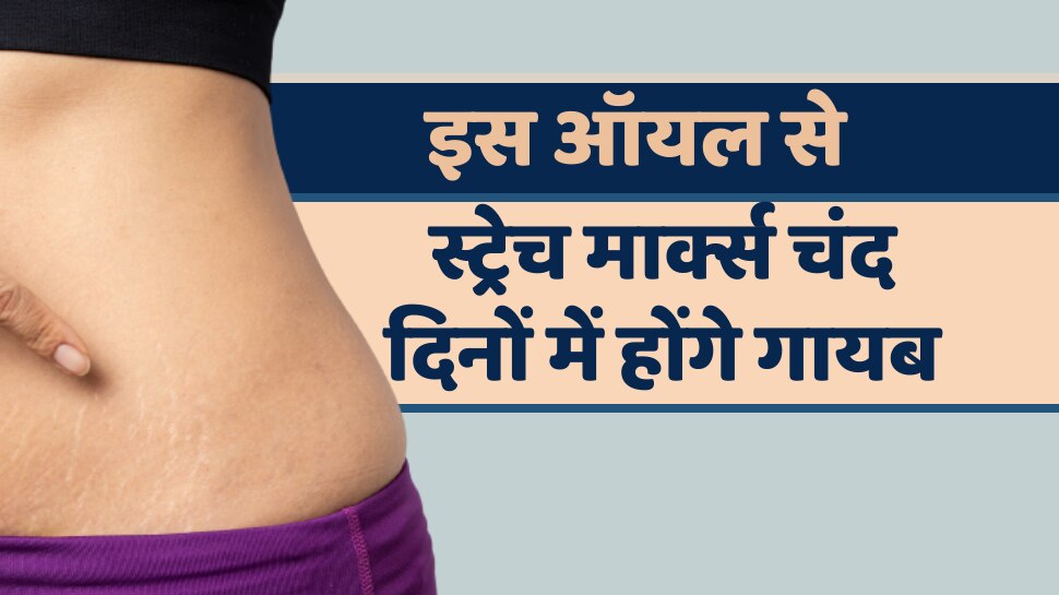 Beauty tips how to remove Stretch marks just use oil Beauty tips