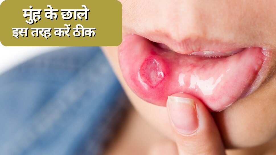 health-tips-natural-remedies-to-cure-mouth-ulcers-it-will-cure-within-a