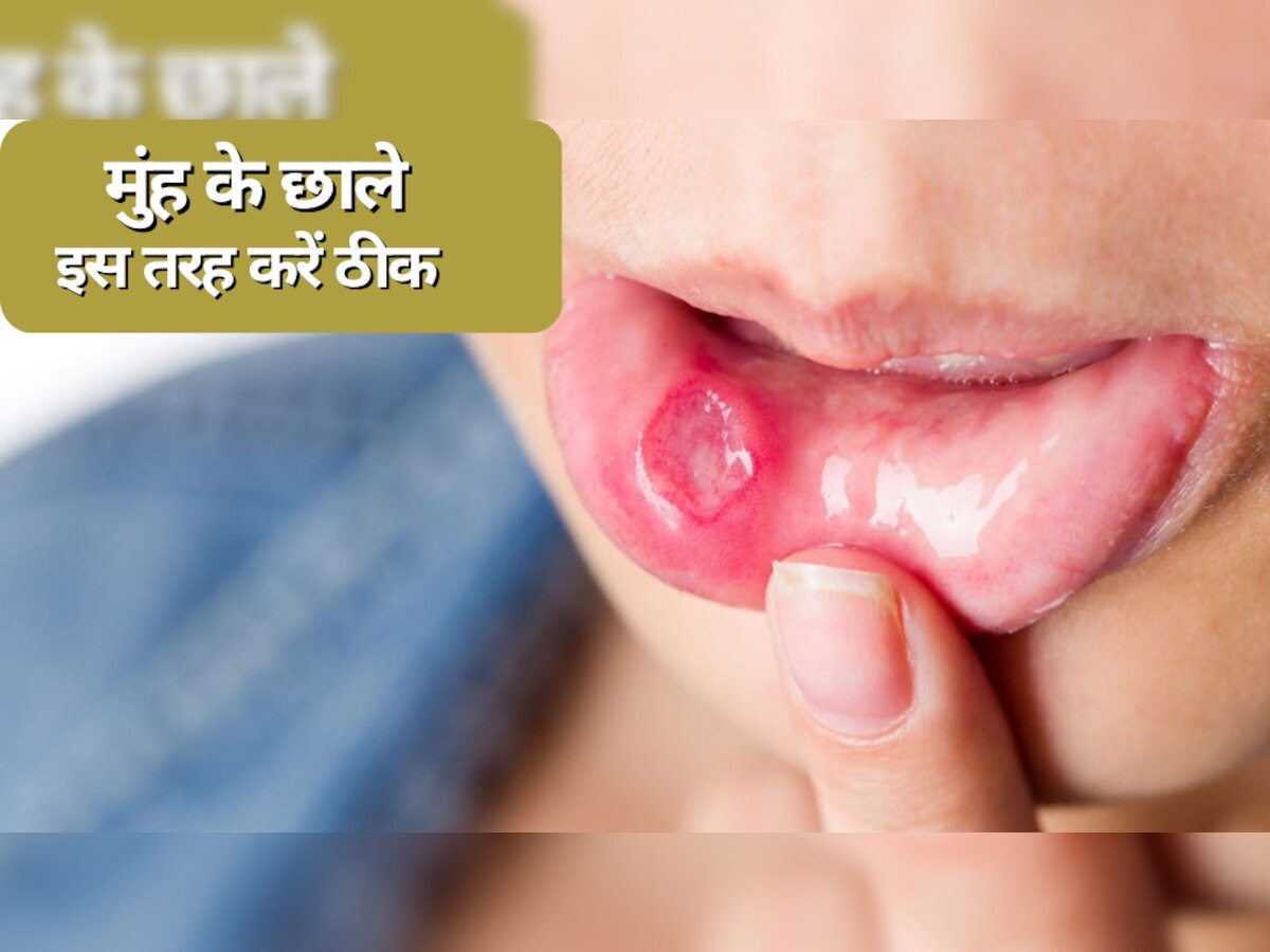 Mouth Ulcer: मुंह के छालों को सिर्फ 5 रुपये में करें ठीक, ये हैं असरदार फॉर्मूला