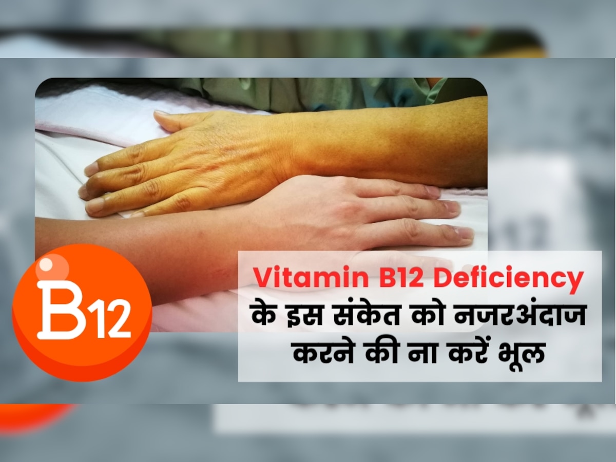 Vitamin 12 Deficiency: विटामिन बी12 की कमी से स्किन का रंग होने लगता है ऐसा, तुरंत हो जाएं सतर्क वरना बड़ी मुसीबत में पड़ जाएंगे आप!