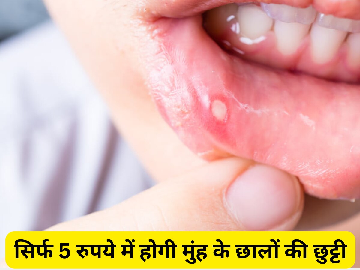 Mouth Ulcer Remedies: पेट की गर्मी से मुंह में पड़ जाते हैं छाले? केवल 5 रुपये दिक्कत होगी दूर