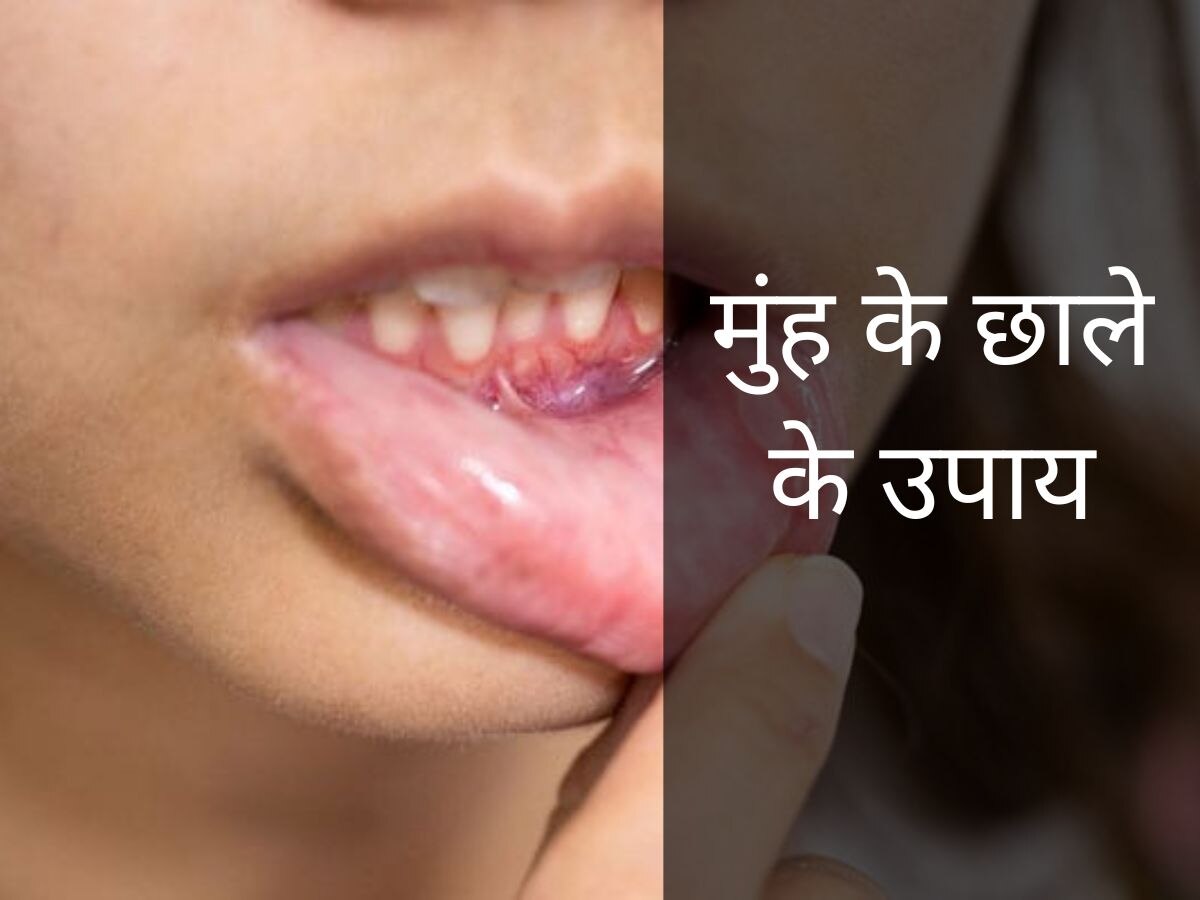 Mouth Ulcers: गर्मी के कारण मुंह में बार-बार निकल रहे हैं छाले? ये 5 घरेलू उपाय दिलाएंगे आराम