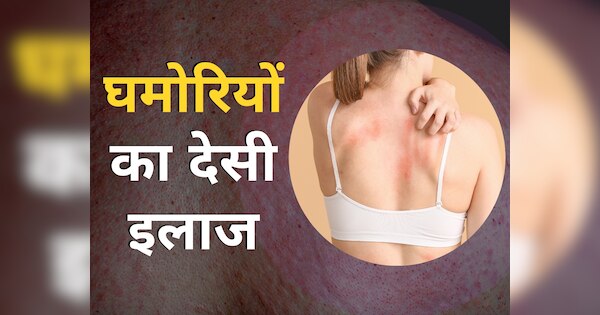 Why do heat rashes occur in summer 5 home remedies to get rid of heat ...