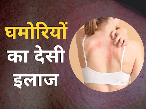 Why do heat rashes occur in summer 5 home remedies to get rid of heat ...