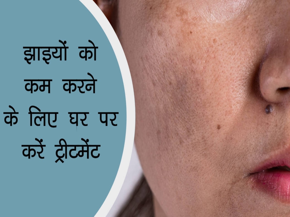 Pigmentation Treatment: छाछ से करें चेहरे की मसाज, झाइयों का होगा सफाया, निखरेगी त्वचा