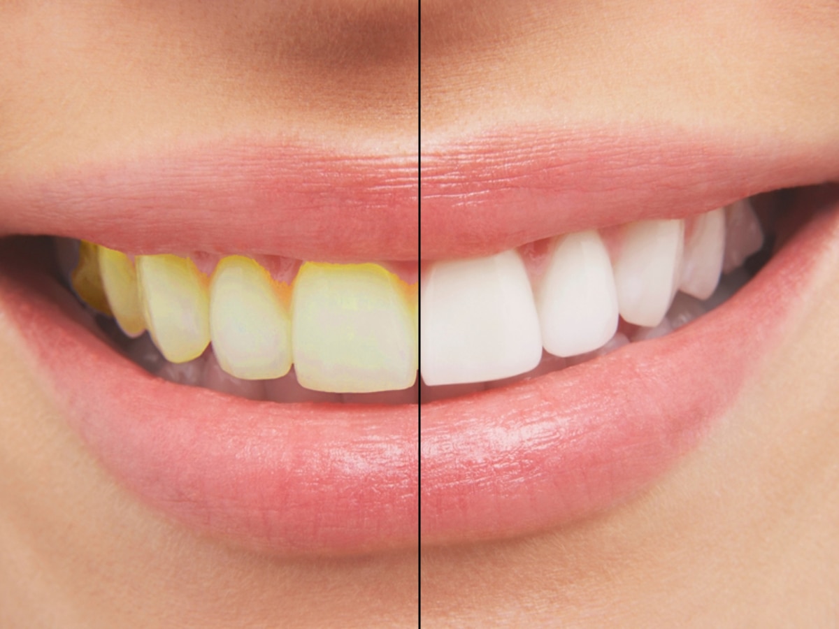 Dental Care Tips: क्या आप भी पाना चाहते हैं मोती की तरह सफेद दांत; अपनाएं ये घरेलू नुस्ख़े