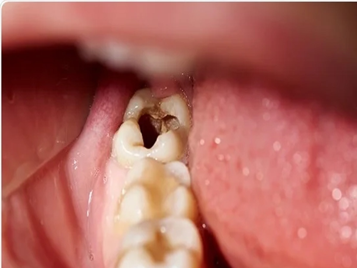 Teeth Cavities: कभी नहीं होगी दातों की समस्या! बस इन बातों की बांध लें गांठ