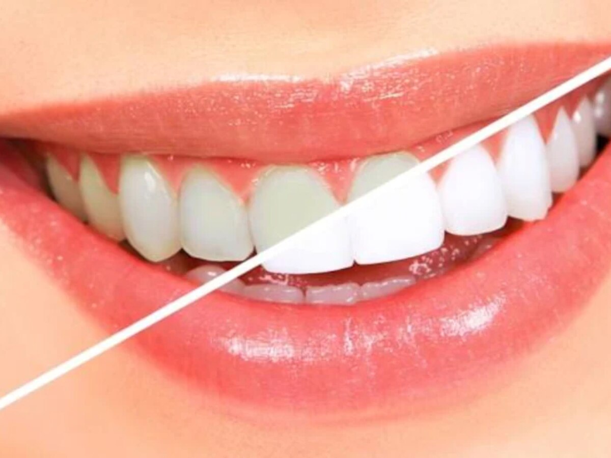 Teeth Cleaning Tips: पीले दांतों से छुटकारा पाने के लिए रोजाना करें ये काम, मोती की तरह चमकेंगे दांत!