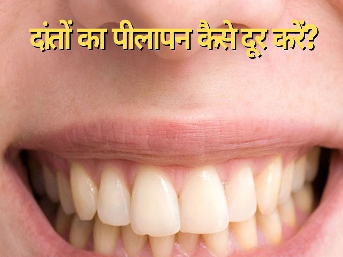 Yellow Teeth Home Remedies: दांतों के पीलेपन से झेलनी पड़ती है शर्मिंदगी? आजमा लें ये 3 घरेलू नुस्खे, चांदी की तरह आ जाएगी चमक 