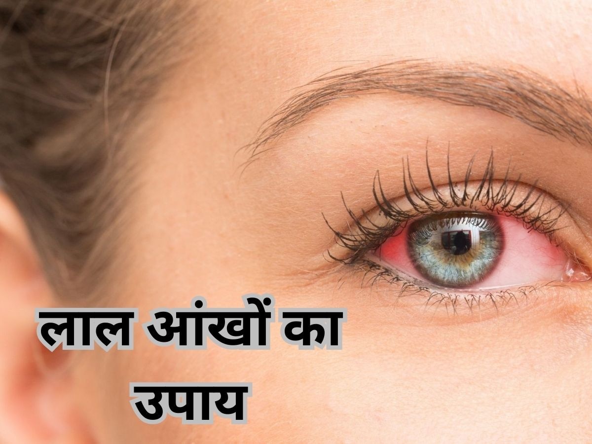 Red Eyes Solution: अगर आंखें दिखने लगी हैं लाल, तो घर पर तुरंत करें ये 5 काम, मिलेगी राहत 