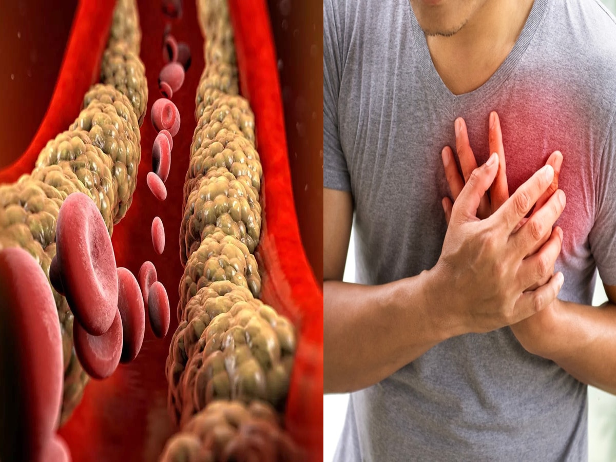 Reduce Bad Cholesterol: करनी होंगी ये पांच चीजें, जड़ से खत्म हो जाएगी कोलेस्ट्रॉल की समस्या