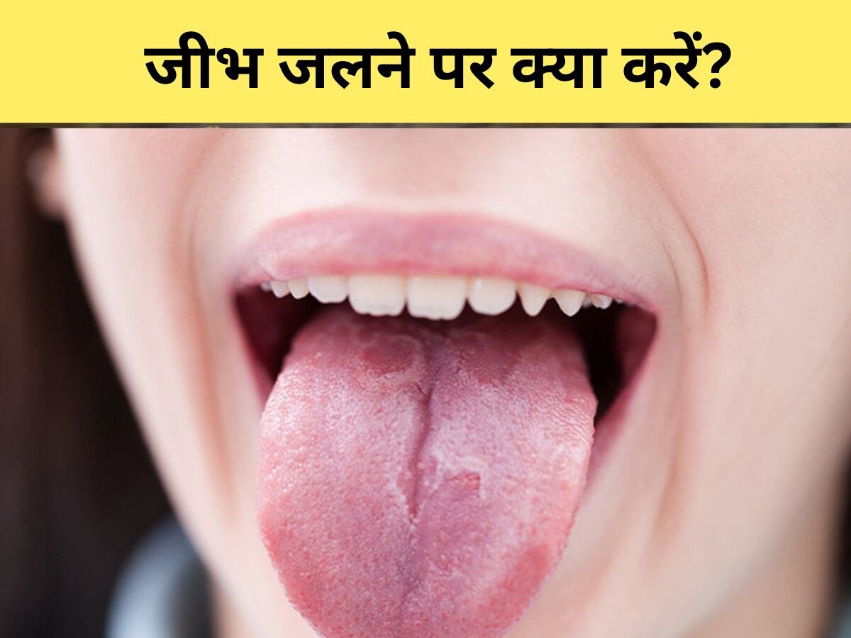 Burnt Tongue- गर्म चीजें खाने से जल गई जुबान? इन देसी उपाय से जल्द मिलेगी राहत