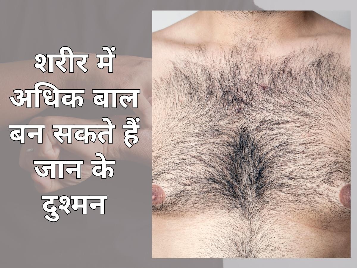 Excessive Body Hair: शरीर में अधिक बाल भी बन सकते हैं जान के दुश्मन! इस तरह पाएं छुटकारा