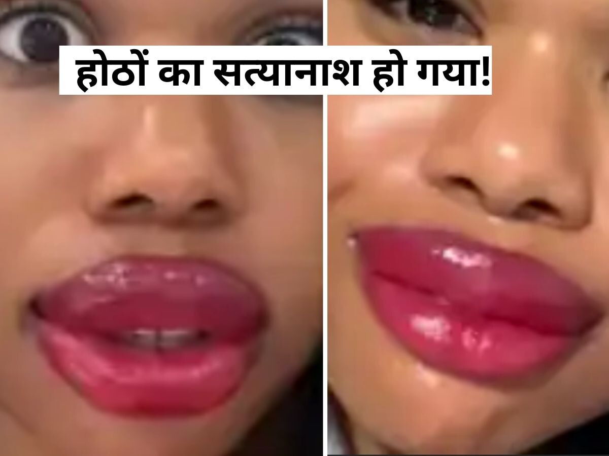 Lip Tattoo: होंठ पर टैटू बनवाना भारी पड़ गया..गुब्बारे जैसा फूल आया, अब मुंह दिखाने के लायक भी नहीं लड़की