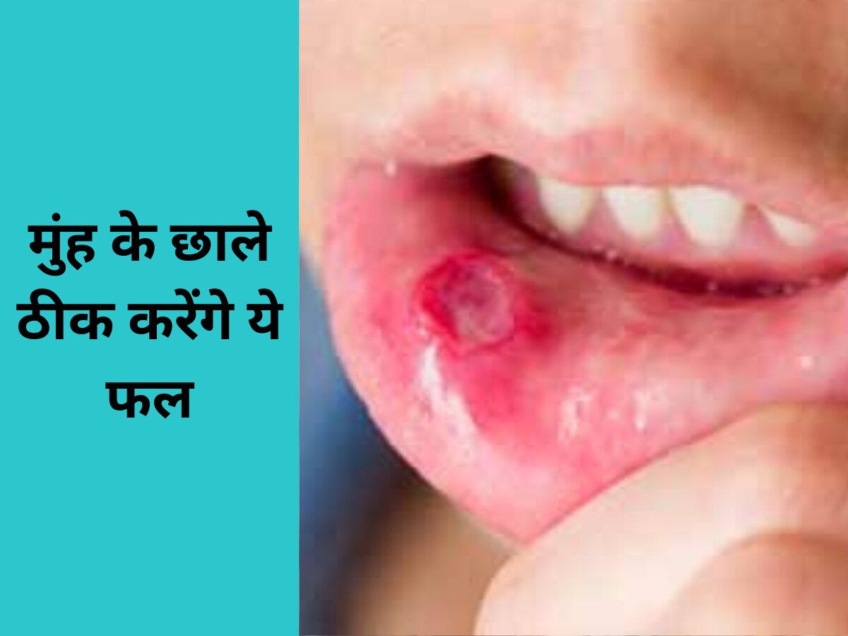 Mouth Ulcer: मुंह के छालों की समस्या दूर करने के लिए खाएं ये फल, फौरन मिलेगा आराम  