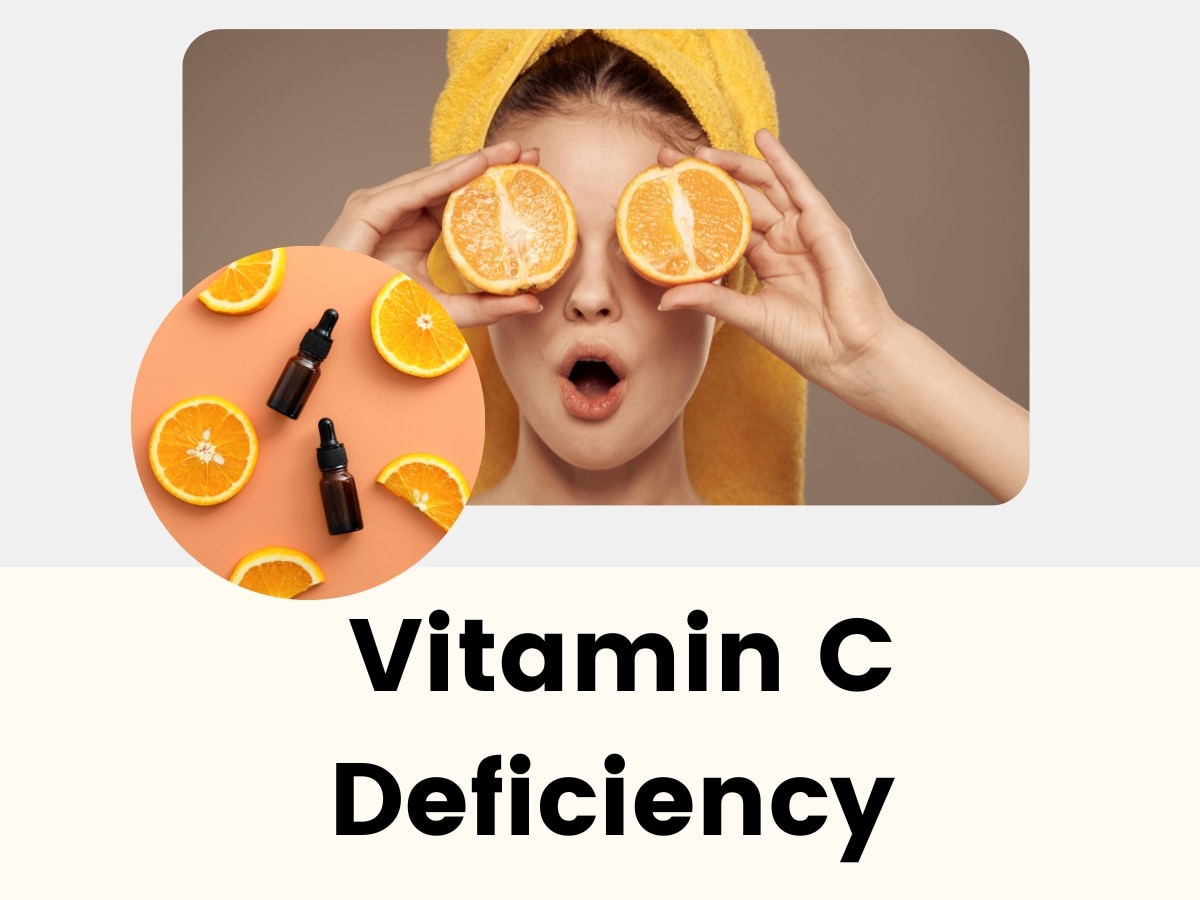 Vitamin C Deficiency: शरीर में विटामिन सी की कमी हो सकती हैं ये 6 स्वास्थ्य समस्याएं, जान लीजिए आप