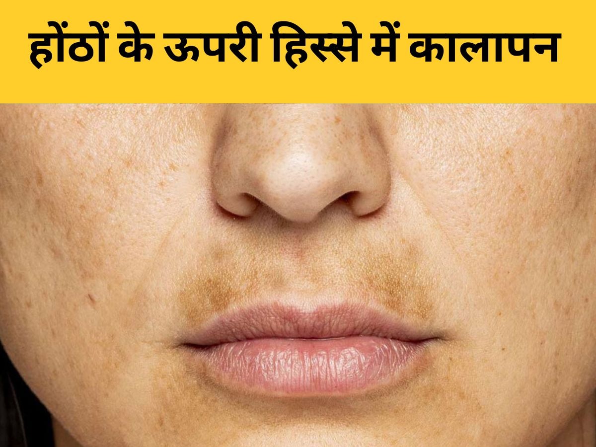 Dark Upper Lips: होंठों के ऊपरी हिस्से में दिखने लगी डार्कनेस? इन घरेलू उपायों से दूर होगा कालापन