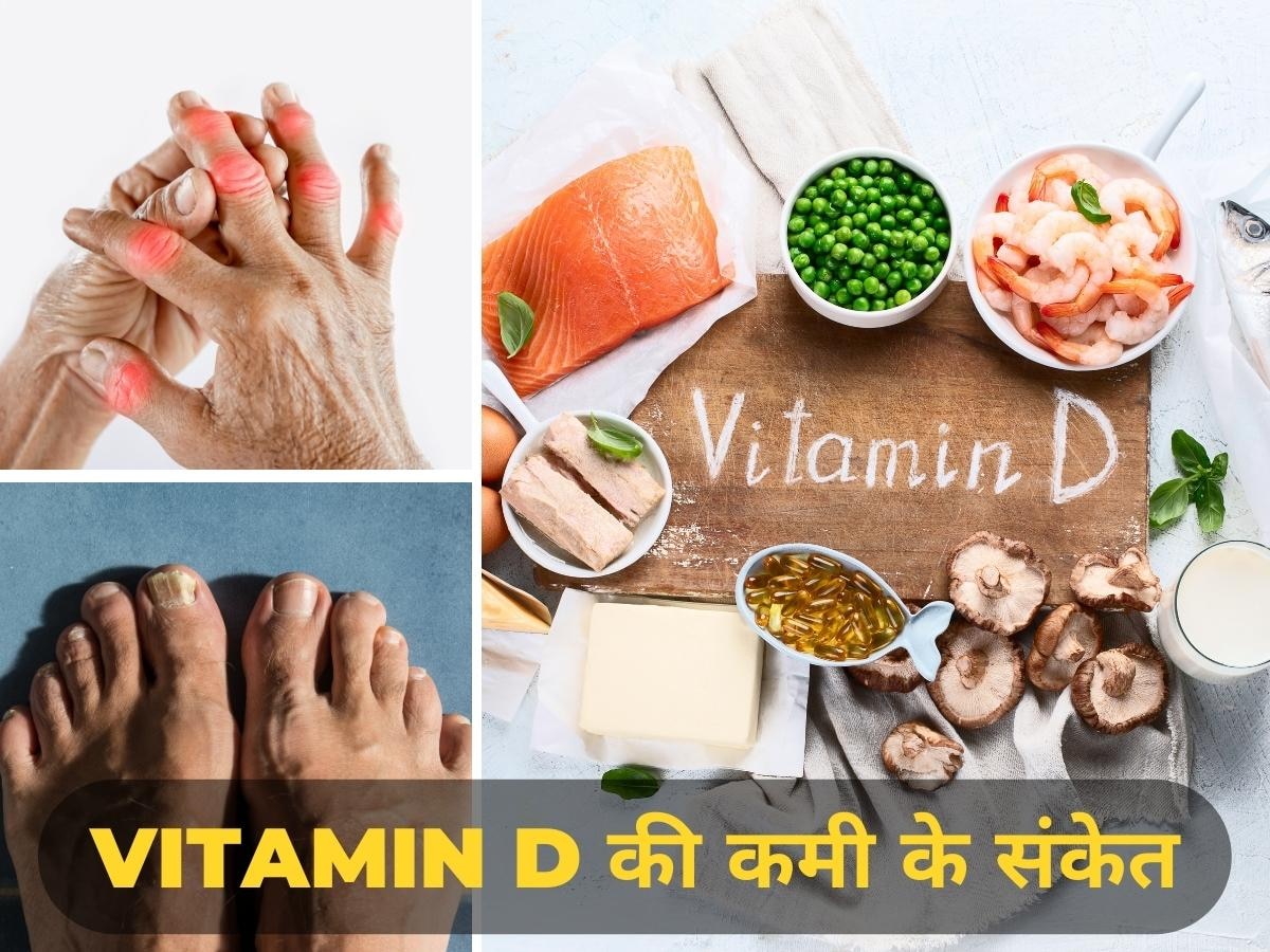 Vitamin D Deficiency: विटामिन डी की कमी से हाथ-पैर की उंगलियों में मिलते हैं ऐसे संकेत, वक्त रहते हो जाएं सतर्क वरना...