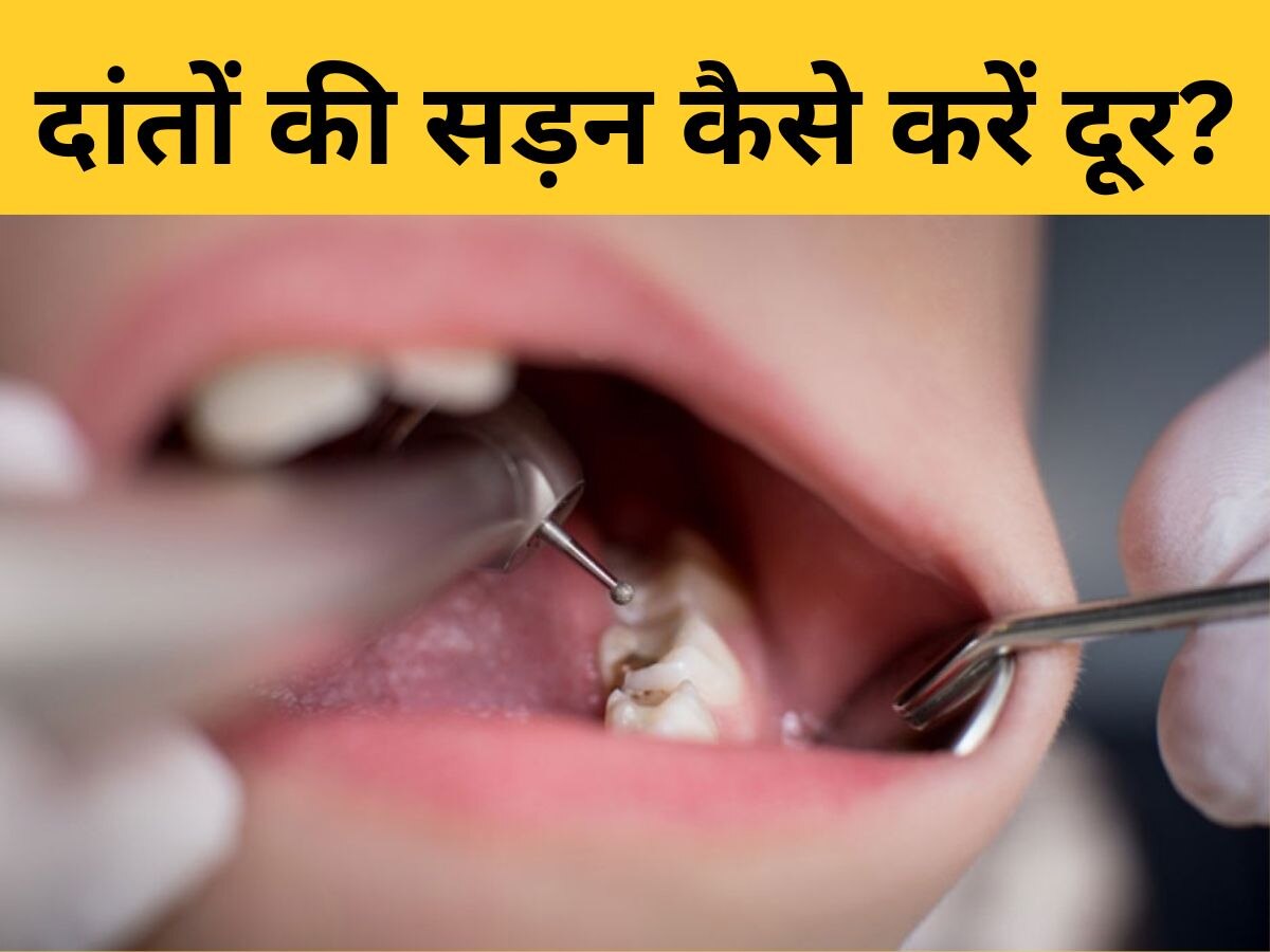 Teeth Cavity: कैविटी ने कर रखा है परेशान? दांतों को सड़न से बचाने के लिए जरूर करें ऐसे उपाय