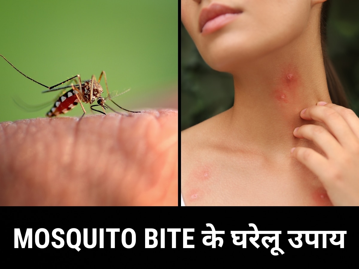 Mosquito Bite: मच्छर के काटने से त्वचा पर निकल आए हैं दाने? इन घरेलू उपायों से करें ठीक