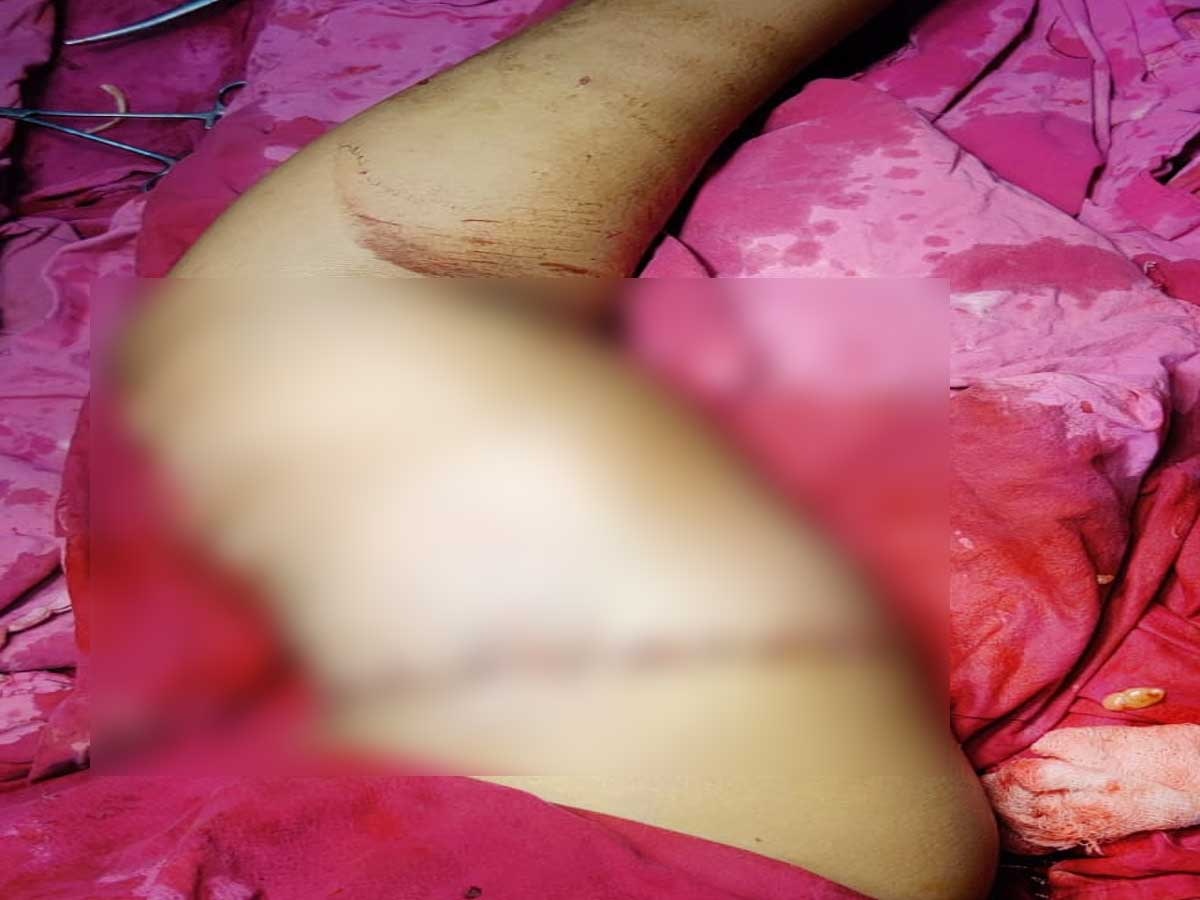 राजस्थान के SMS अस्पताल ने युवक को दिया जीवनदान, सर्जरी कर हटा हुाथ जोड़ा