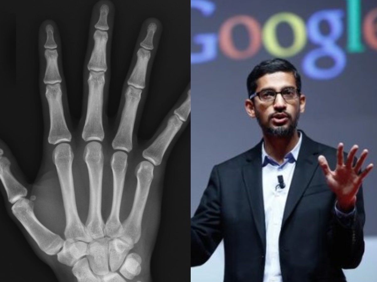 Google AI: अब X-ray, CT Scan और MRI नहीं पड़ेगी जरूरत! आंखों की स्कैनिंग से ही हो जाएगा सारा काम