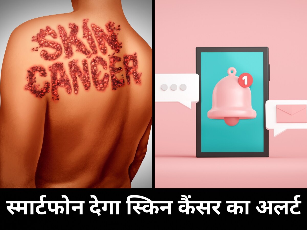 Skin Cancer: स्किन कैंसर का अलर्ट देगा स्मार्टफोन, स्वदेशी बैंडेज से होगा इलाज