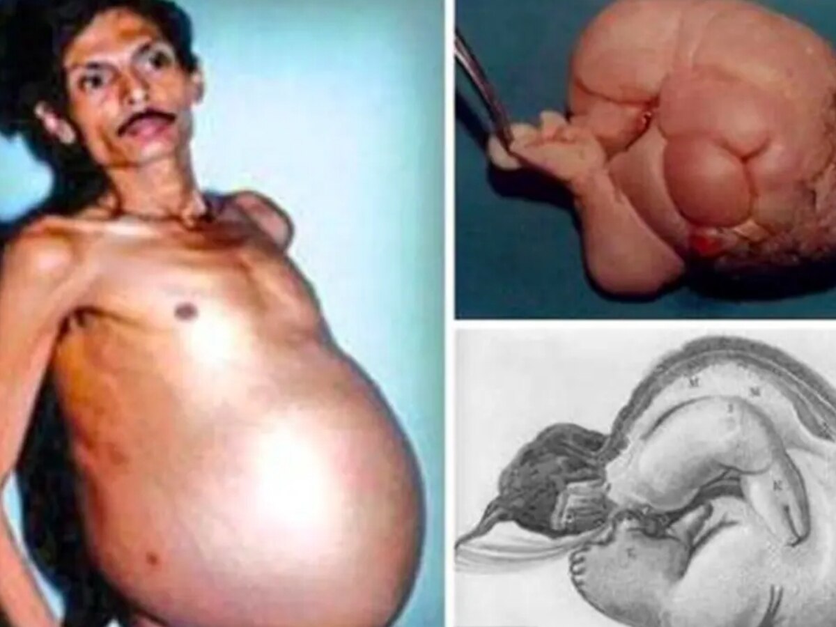 Pregnant Man: 36 साल तक फूले पेट को समझता रहा ट्यूमर, जब सच्चाई पता चली तो डॉक्टरों के भी उड़ गए होश