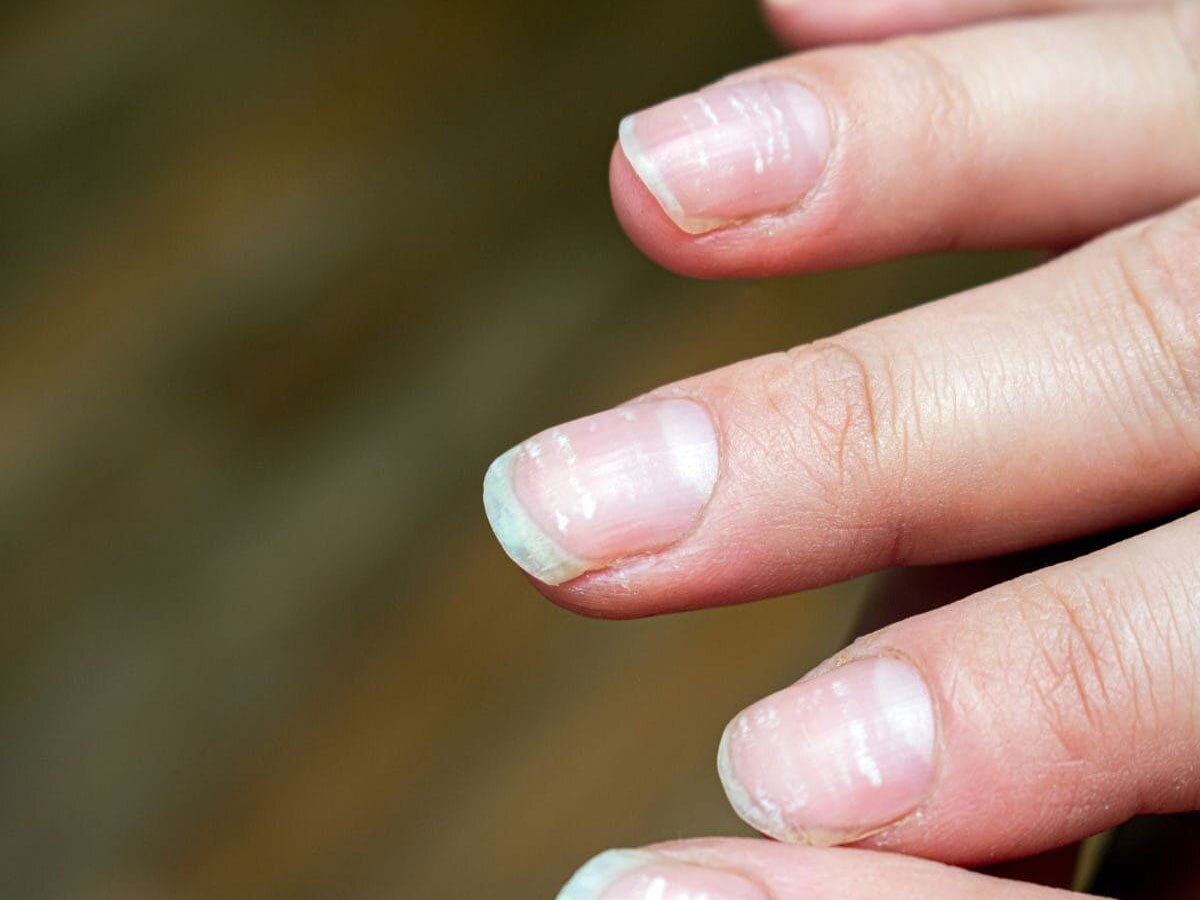 Health News This disease caused by white spots on nails नाखून पर सफेद