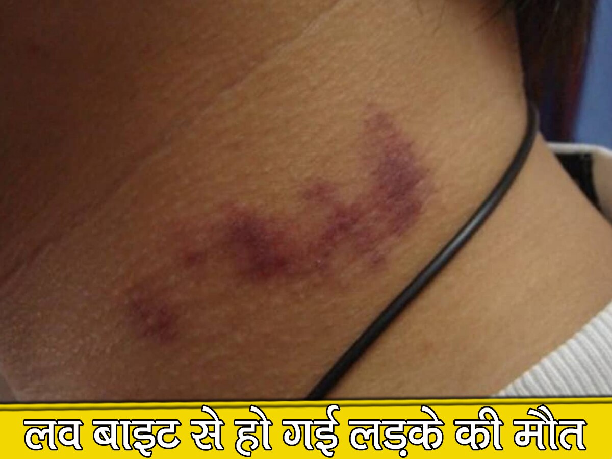 boyfriend died due to girlfriend love bite know what is the reason