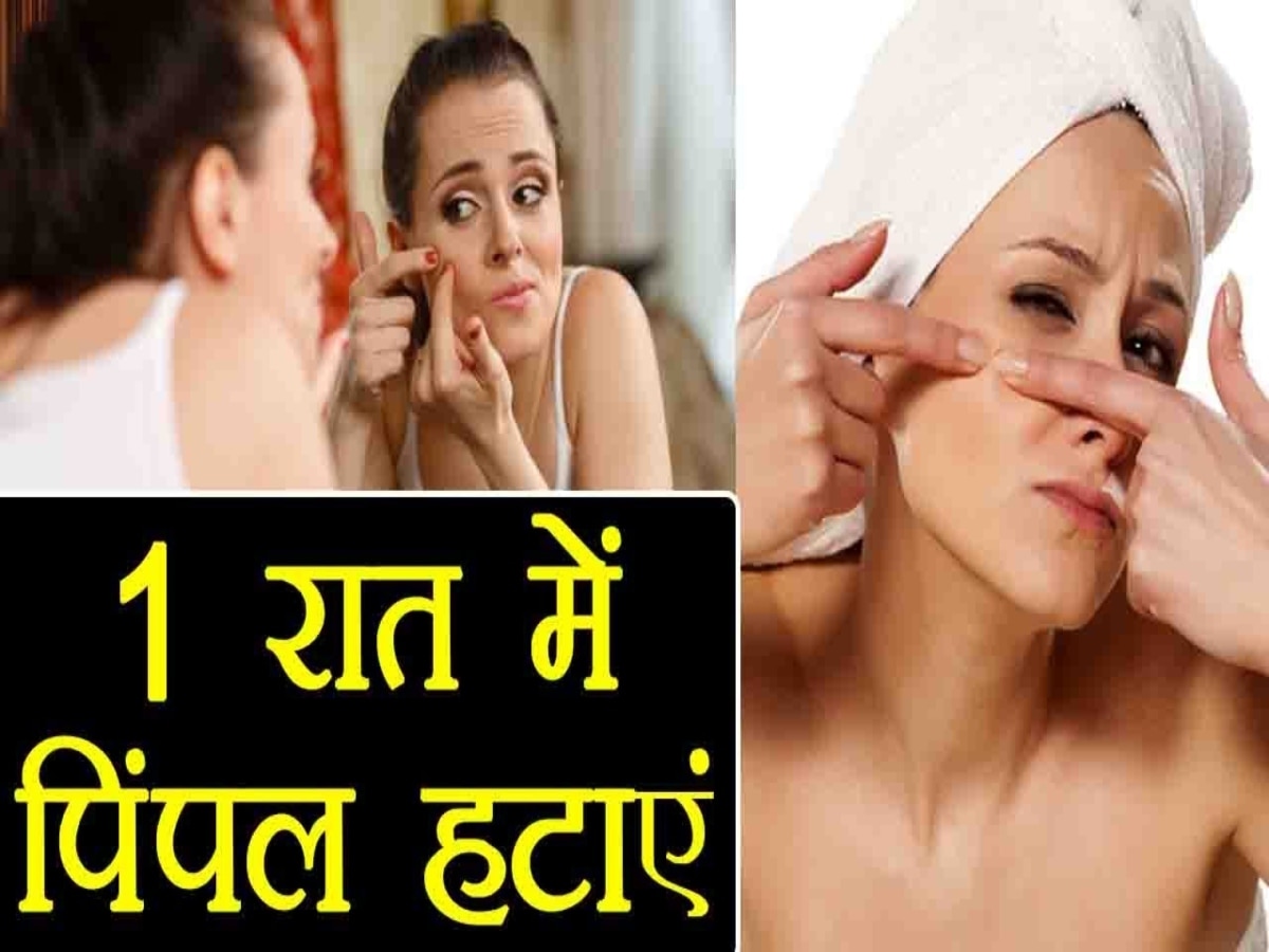 Pimples Cure Tips: 1 ही रात में पाना चाहते हैं पिंपल्स से छुटकारा, तो आजमाएं ये 5 असरदार उपचार