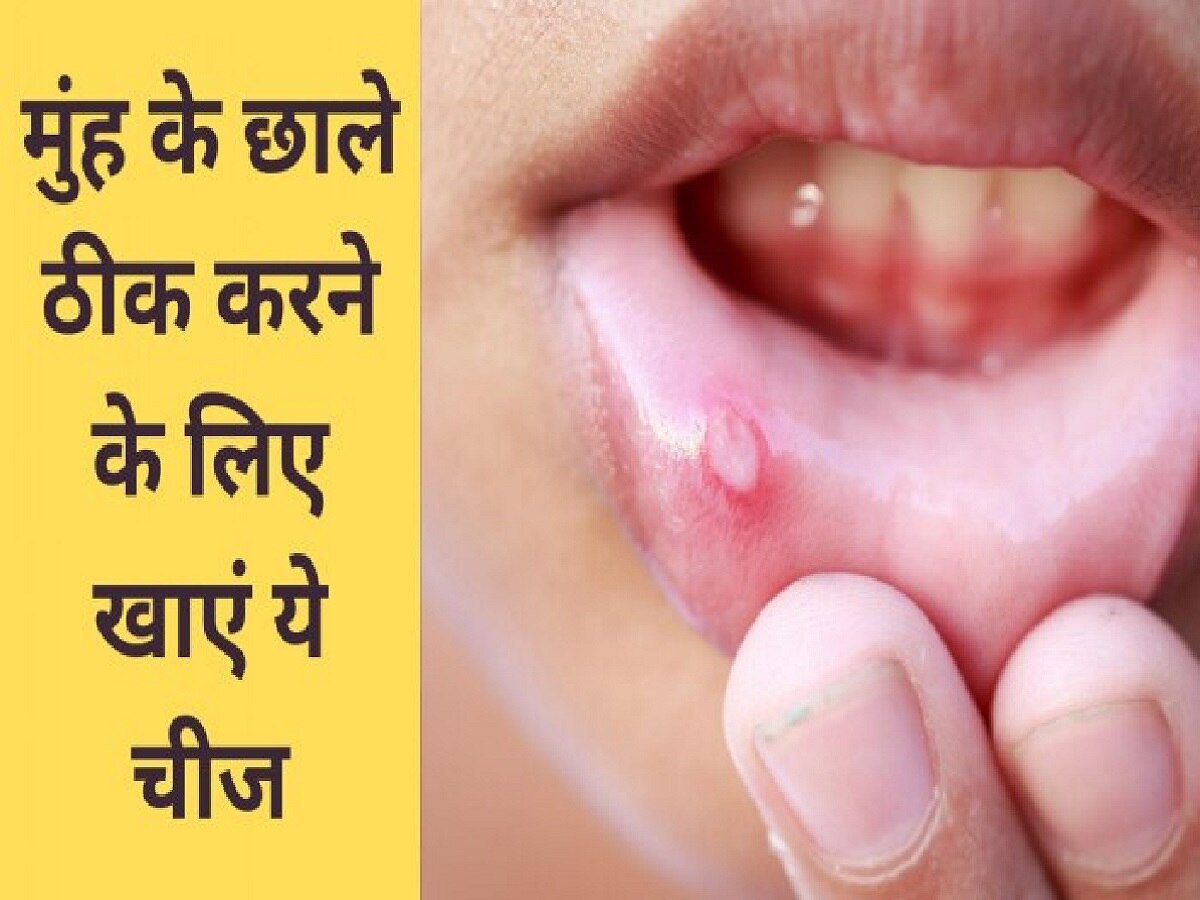 home-remedies-to-cure-blisters-home-remedies-for-mouth-ulcers