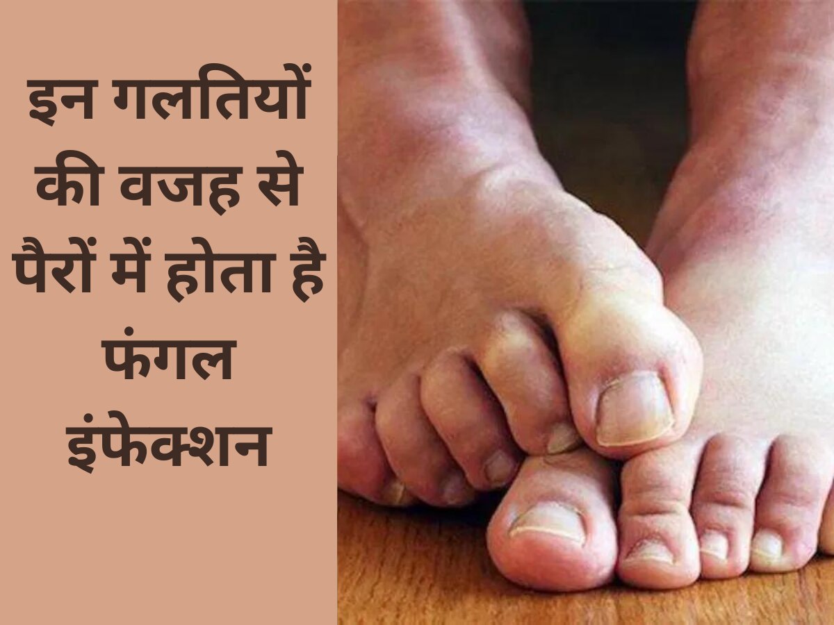 Fungal Infection: मानसून में भूलकर भी न करें ये गलतियां, पैरों में हो सकता है फंगल इंफेक्शन