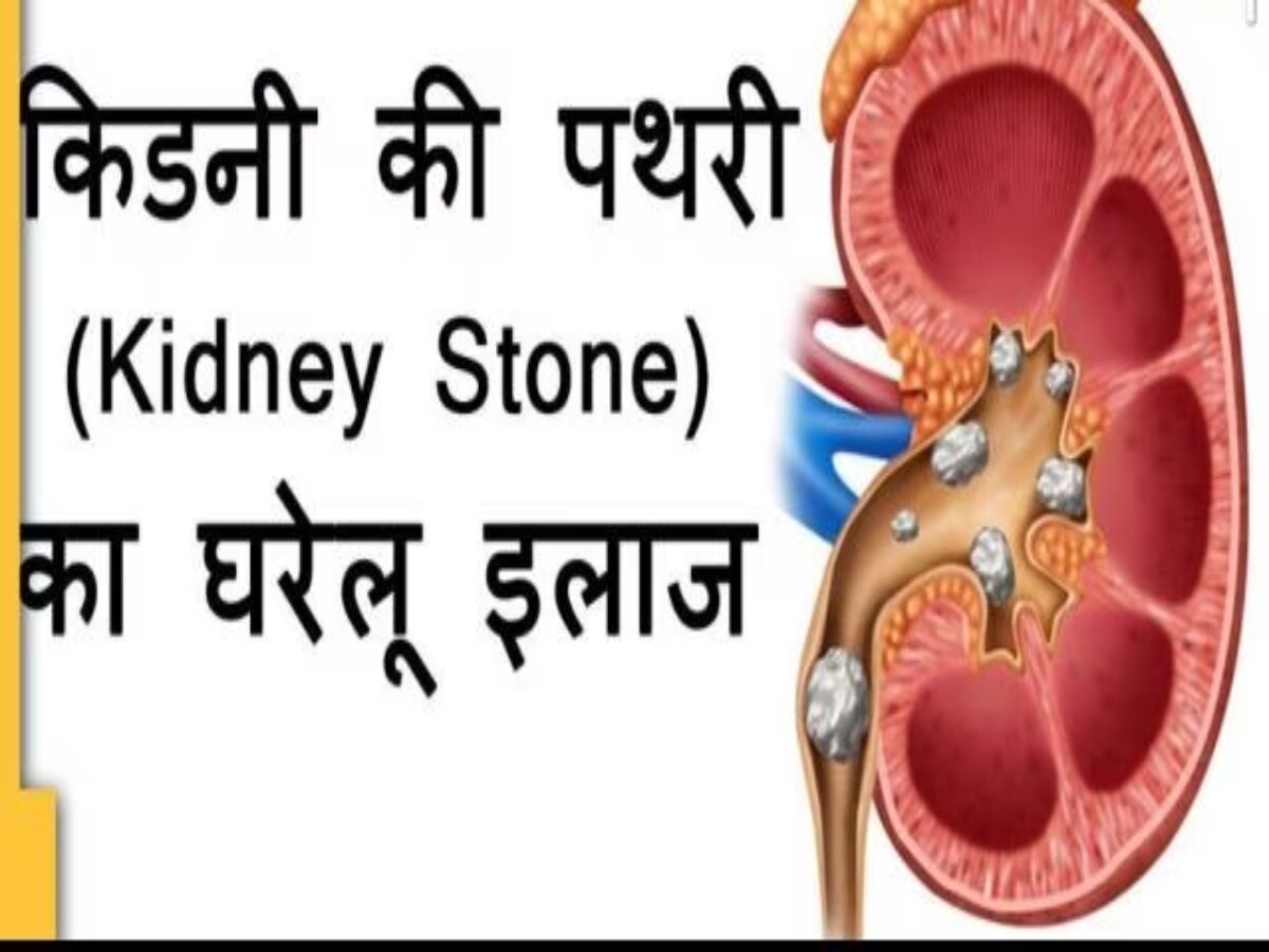 Kidney Stone: किडनी स्टोन की समस्या में डेली बनाकर पीएं Nutritionist द्वारा बताई ये ड्रिंक, पाएंगे आराम  