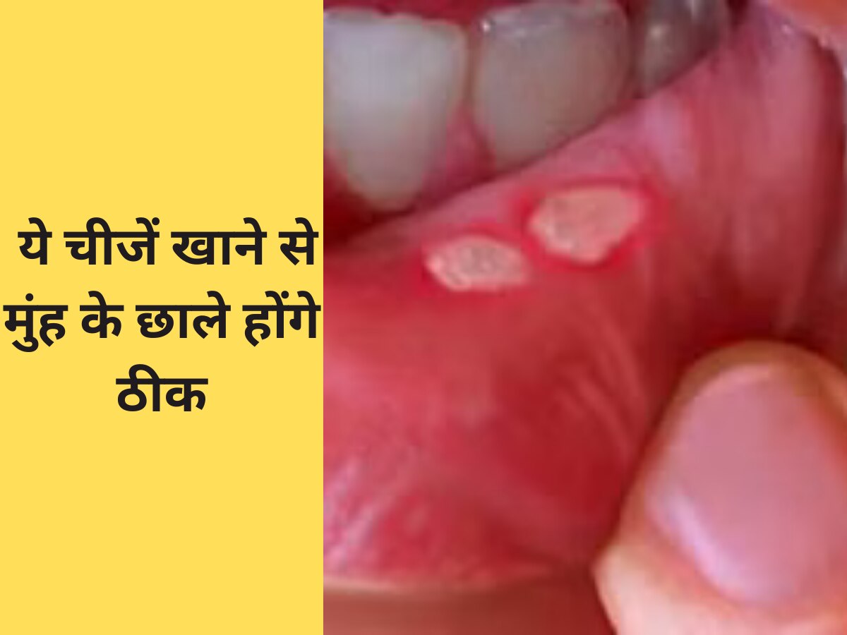 Mouth Ulcers: मुंह के छालों से हैं परेशान? इन चीजों को खाना कर दें शुरू, मिलेगा आराम