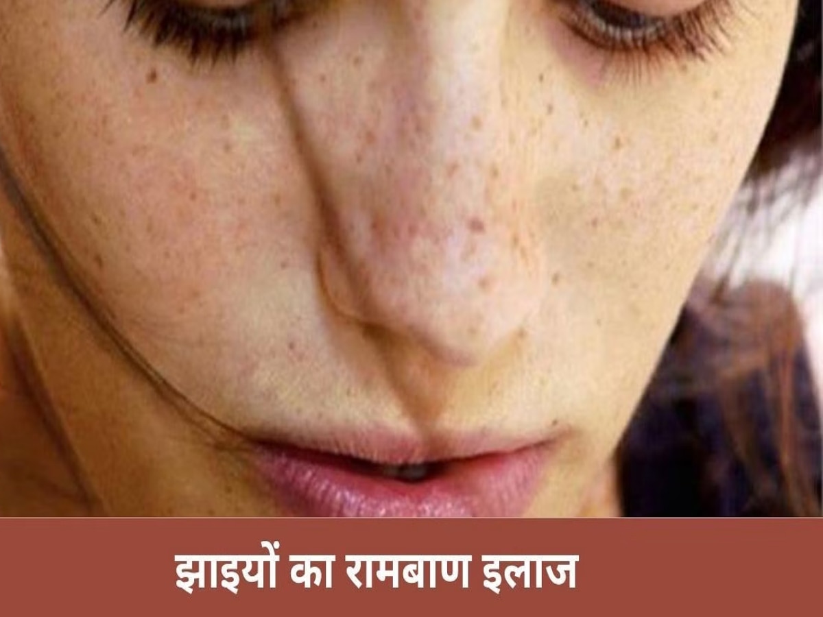 Freckles Treatment: मात्र 15 दिनों में झाइयों का हो जाएगा पूरी तरह से सफाया, बस लगाएं ये 1 चीज